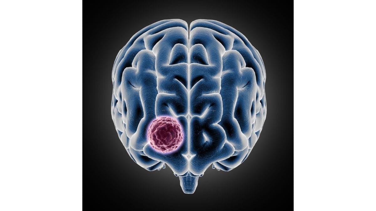 meningioma